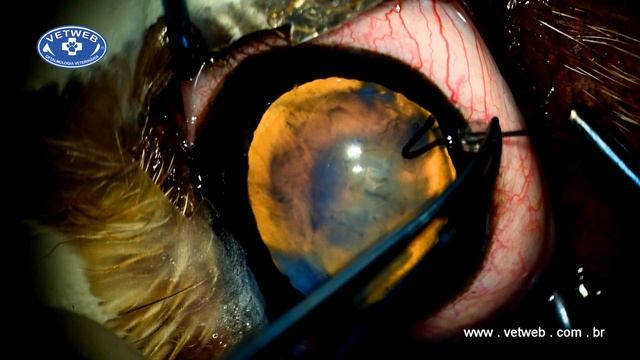 Capsule Hooks during Cataract Surgery смотреть онлайн