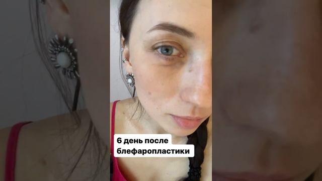 Нижняя трансконьюктивальная блефаропластика , блефаропластика нижних век, нижняя блефаро смотреть онлайн