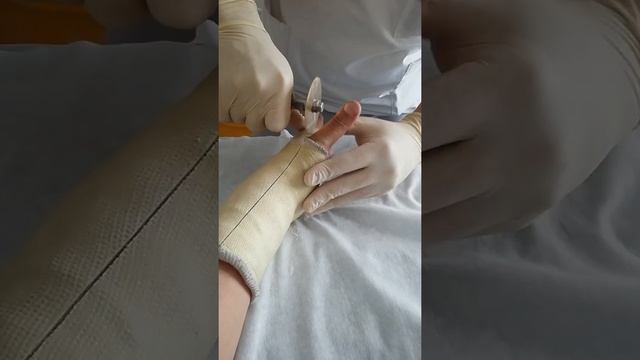 Снять пластиковый гипс смотреть онлайн