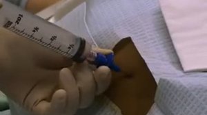 Аспирация и биопсия костного мозга