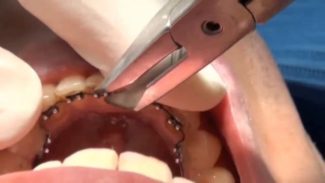 2D — открывание брекетов, Dr. Alexander Gebhardt смотреть онлайн