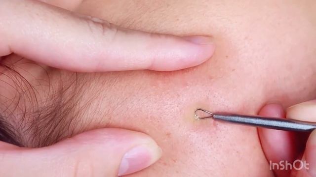 Blackheads | чёрные точки