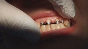 Металлокерамические коронки простая-сложная работа. 4я стоматология (архивное видео 26.04.2023).
