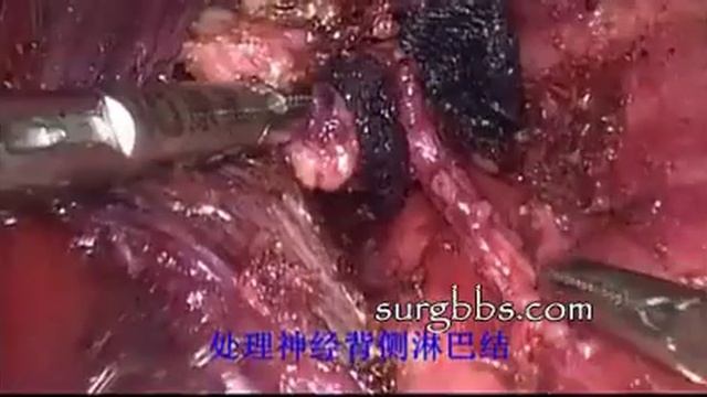 The breast areola approach endoscopic bilateral thyroidectomy and bilateral central lymph node diss смотреть онлайн