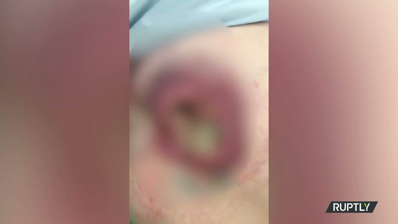 Гнила Заживо в больнице. СК возбудил уголовное дело. смотреть онлайн