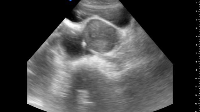 OVARIAN CYST, ULTRASOUND: FREE FLUID IN VESICOUTERINE POUCH( UTEROVESICAL SPACE) смотреть онлайн