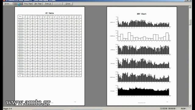 Holter Software Report 12 leads ECG Contec TLC5000%2C www amtc gr смотреть онлайн