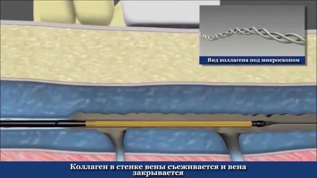 Радиочастотная абляция вен при варикозе. РЧА на ногах смотреть онлайн