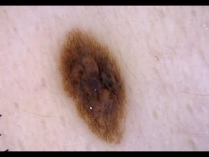 КАК ОПРЕДЕЛИТЬ МЕЛАНОМУ? - случаи из врачебной практики 2021г.
