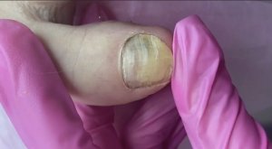 Онихолизис