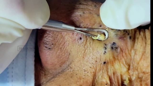 Massive Blackhead Removal Inside A Dermatology Clinic | @Dr.AMAZINGSKIN