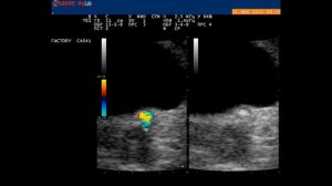 МКБ: Камень левого мочеточника. Twinkling artifact. УЗИ