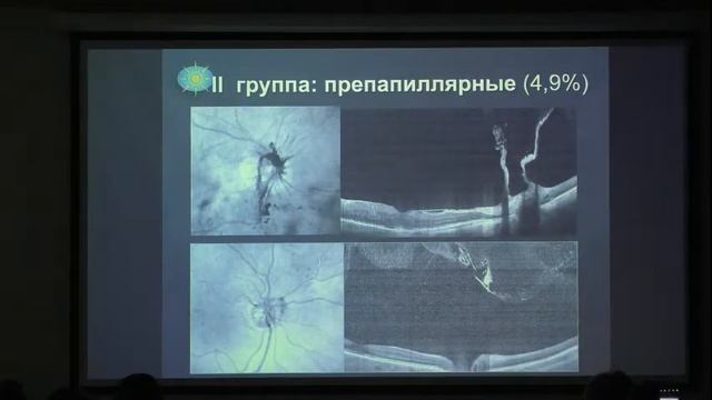 Лазерный витреолизис плавающих помутнений стекловидного тела смотреть онлайн