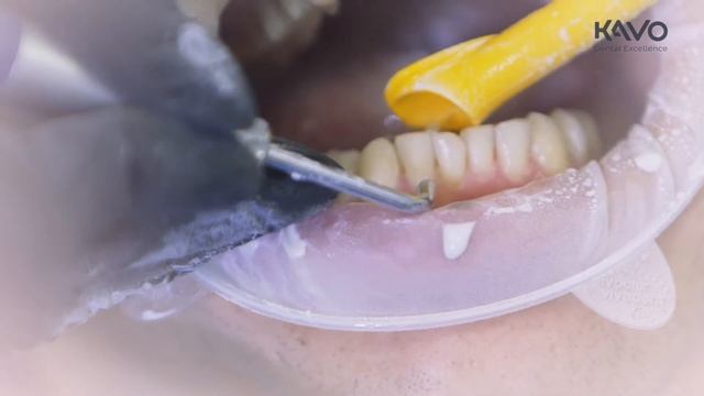 Работа с воздушно-порошковым наконечником KaVo PROPHYflex4 смотреть онлайн