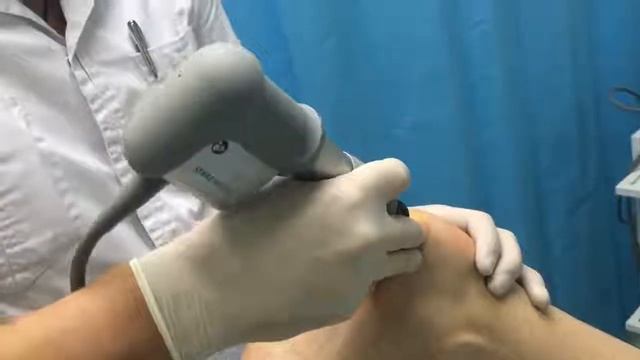 Лечение пяточной шпоры с помощью ударно-волновой терапии (УВТ) смотреть онлайн