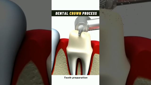 #dental #crown #process смотреть онлайн