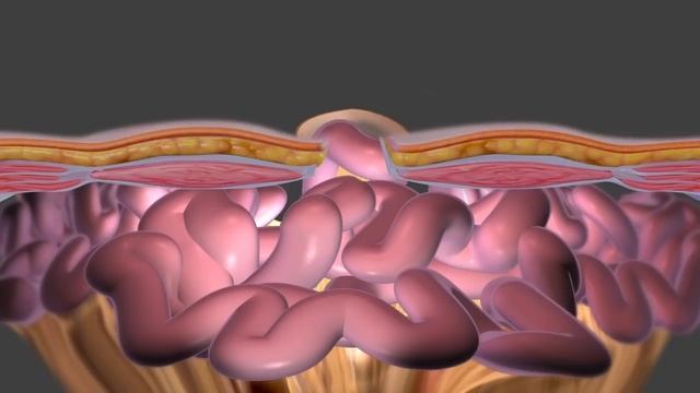 Repairing a Hernia with Surgery смотреть онлайн