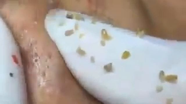 Extracion de espinillas y barros смотреть онлайн