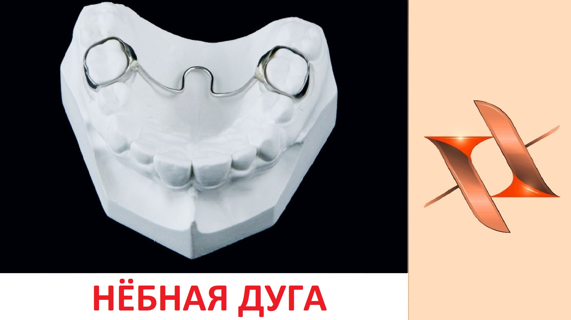 Нёбная дуга. (Нёбный бюгель) Ортодонтия.