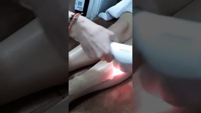 Диодная лазерная эпиляция смотреть онлайн