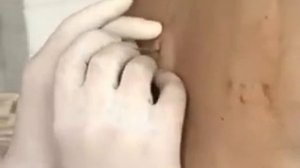 эпидуральная анестезия ( Epidural anesthesia )