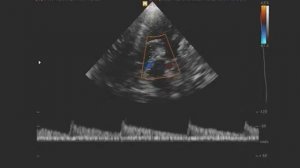 Ускорение кровотока в вене Розенталя