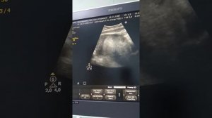 Первый скрининг 11 недель и 4 дня