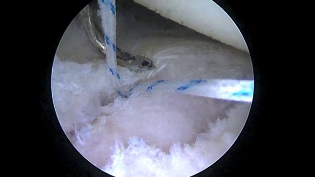 JL R Subpectoral Biceps Tenodesis  7.30.15