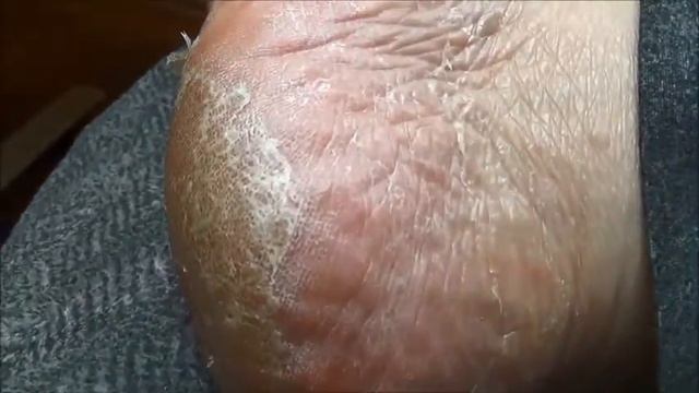 Best Product To Fix Dry Cracked Heels And Cheap $3.99 смотреть онлайн