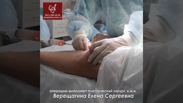 Липофилинг голеней смотреть онлайн