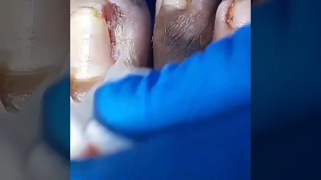 Удаления ногтя вросшигося в палец ноги