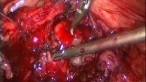 Лапароскопическая пластика мочепузырно-влагалищного свища в ранние сроки