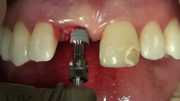 NobelReplace Conical Connection Cirugía