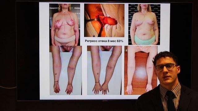 Ивашков Владимир Юрьевич. Лечение лимфостаза/лимфедемы.