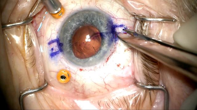PPV and phacofragmentation/IOLexchange/Yamane ISHF by Steven G. Safran MD смотреть онлайн