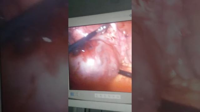 Апоплексия кисты яичника. смотреть онлайн