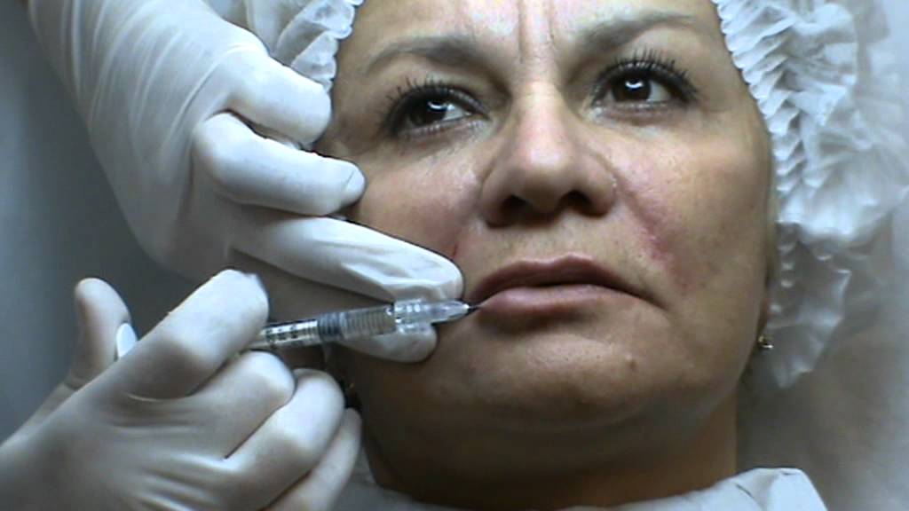 Princess Filler, контурная пластика лица, видео, обучение смотреть онлайн