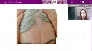 Лекция 17  Заболевания соединительной ткани  Склеродермия  Красная волчанка