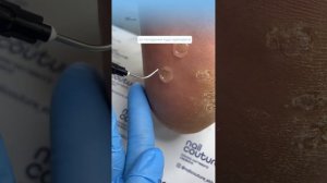 Как правильно работать с бородавками на стопе?