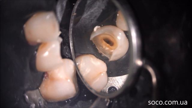 Протокол повторной эндодонтии файлами Sani смотреть онлайн