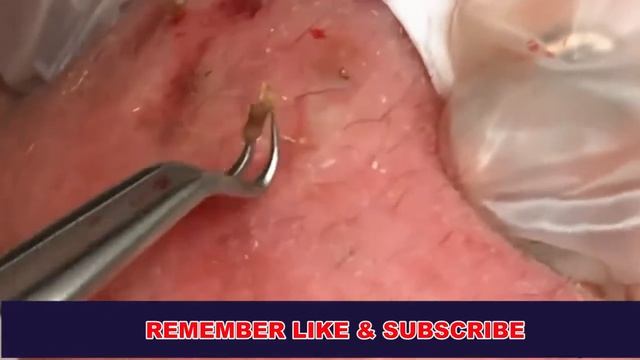 удаление черной головы с лица естественным смотреть онлайн