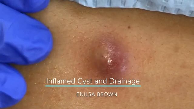 Enilsa's Top 5 Best Cyst Popping Compilation