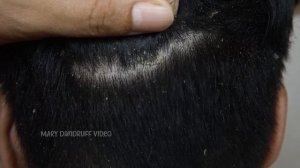 Почесывание больших хлопьев от перхоти #867