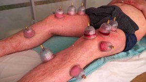 Как делается Хиджама на ноги? | Хиджама Авиценна