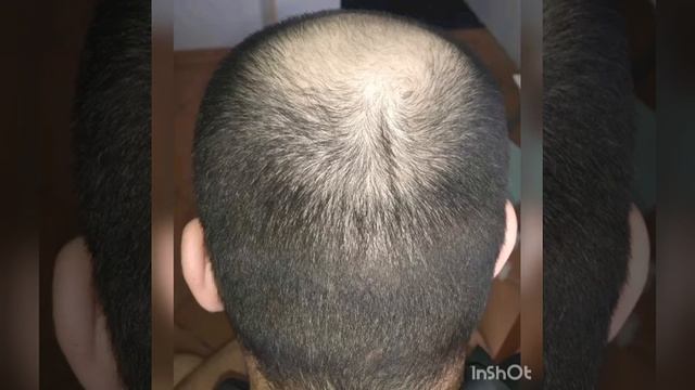 ALERANA 5% пока первый 2 месяца использование и такой результат)! смотреть онлайн