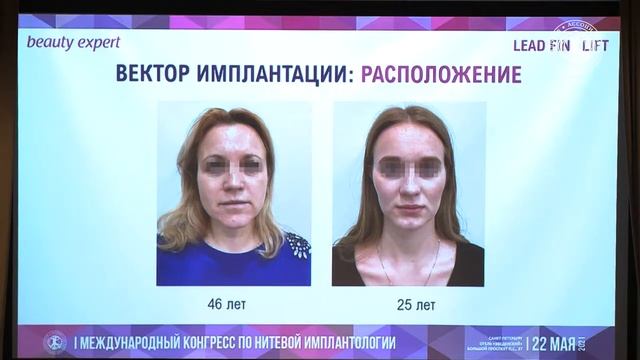 I Международный конгресс по нитевой имплантологии. Выступление Старковой Елены Юрьевны