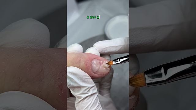 Ковыряет себе ногти / Самодеструкуция / Что с ногтями? Ковыряет ногти что делать? смотреть онлайн