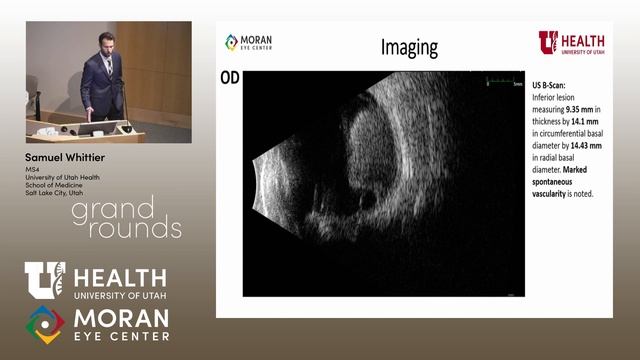 Choroidal Melanoma смотреть онлайн