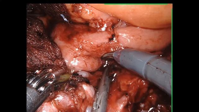 RPLND : robotic retroperitoneal lymph node dissection carcinoma testis смотреть онлайн