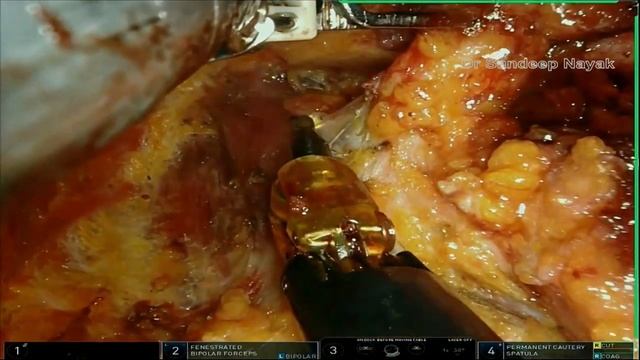 Session 9, Robotic Inguinal Lymphadenectomy, Humans on the Cutting Edge of Robotic Surgery смотреть онлайн